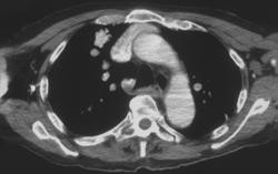 Pulmonary Arteriovenous Malformation (PAVM) - CTisus CT Scan