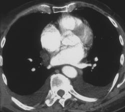 Bronchogenic Cyst - CTisus CT Scan