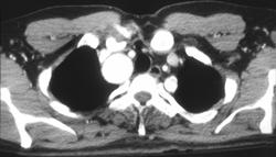 Innominate Artery Aneurysm - CTisus CT Scan