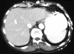 Abdominal Wall Collaterals Due to Superior Vena Cava (SVC) Syndrome - CTisus CT Scan