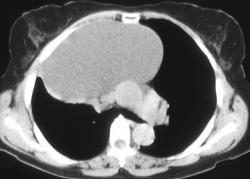 Thymic Cyst - CTisus CT Scan