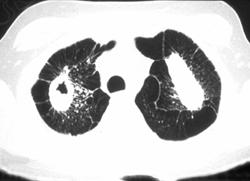 Tuberculosis (TB) Simulating Silicosis - CTisus CT Scan