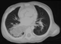 Cystic Adenomatoid Malformation (CAM) - CTisus CT Scan