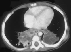 CAM (see Prior Case) - CTisus CT Scan