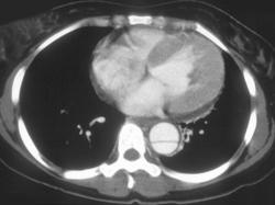 Aortic Dissection - CTisus CT Scan