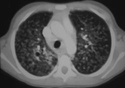 Tuberculosis (TB) - CTisus CT Scan