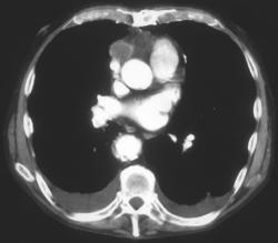 Aneurysm of Coronary Artery Bypass Graft - CTisus CT Scan