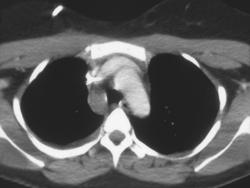 Mediastinal Hematoma - CTisus CT Scan