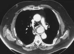 Old Traumatic Aneurysm - CTisus CT Scan