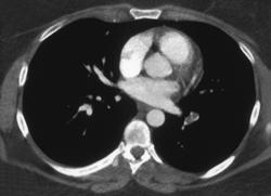 Pulmonary Embolism - CTisus CT Scan