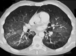 PCP in AIDS Patient - CTisus CT Scan