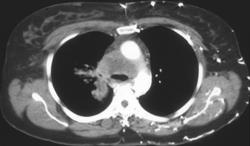 Superior Vena Cava (SVC) Syndrome Due to Small Cell Lung Cancer - CTisus CT Scan