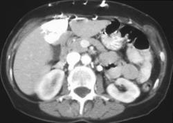 Hot Spot Liver Due to SVC Occlusion - CTisus CT Scan