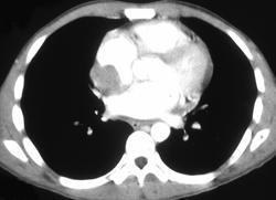 Lymphoma Involves Right Atrium - Chest Case Studies - CTisus CT Scanning