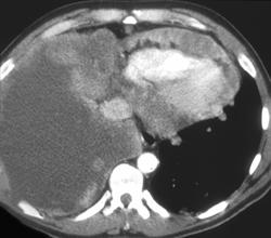 Melanoma Involves Heart and Pericardium - CTisus CT Scan