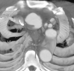 Mycotic Aneurysm - CTisus CT Scan