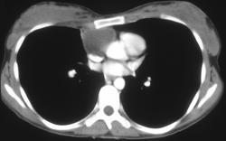 Angiosarcoma - CTisus CT Scan