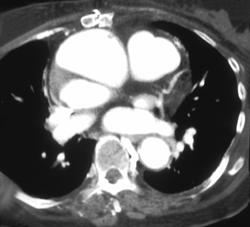 Aortic Dissection - CTisus CT Scan