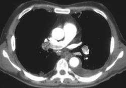 Pulmonary Embolism - CTisus CT Scan