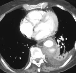 Aortic Dissection With Leak - CTisus CT Scan