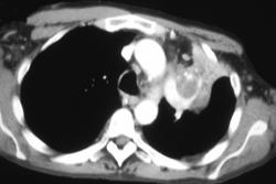 Lung Cancer With Adrenal Metastases - CTisus CT Scan