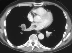 Metastatic Thyroid Cancer Invades the Left Atrium - CTisus CT Scan