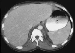 Posterior Mediastinal Nodes Due to Mai Infection - CTisus CT Scan