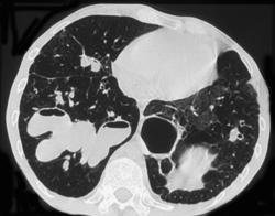 Incredible Bronchiectasis - CTisus CT Scan