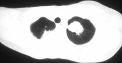 Aspergillosis - CTisus CT Scan