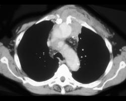 Pseudoaneurysm Following Coronary Artery Bypass Graft (CABG) - CTisus CT Scan