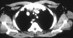 Aberrant Right Subclavian Artery - CTisus CT Scan