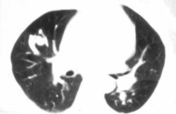 Pulmonary Arteriovenous Malformation (PAVM) - CTisus CT Scan