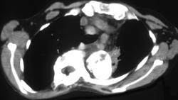 Neurogenic Tumor (calcified) - CTisus CT Scan