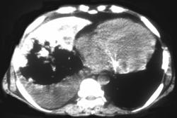 Pulmonary Calcification Due to Renal Failure - CTisus CT Scan