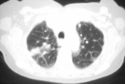 Lymphangitic Spread of Breast Cancer - CTisus CT Scan