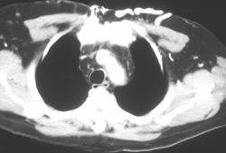 SVC Syndrome With Collaterals - CTisus CT Scan