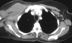 Breast Cancer Invades Muscle - CTisus CT Scan