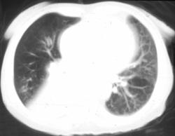 Right Lower Lobe Collapse Due to Central Tumor - CTisus CT Scan