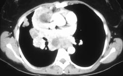 Cystic Lymphoma - CTisus CT Scan