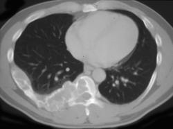 Fibrous Dysplasia - CTisus CT Scan