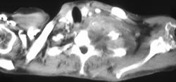 Pancoast Tumor - CTisus CT Scan