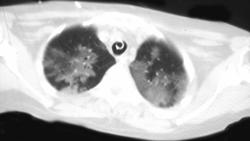 PCP - CTisus CT Scan