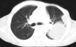 Loculated Emphysema - CTisus CT Scan