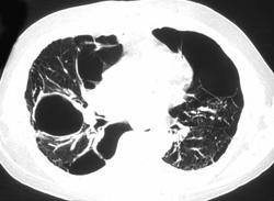 Blebs and Emphysema - CTisus CT Scan