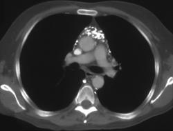 SVC Syndrome With Mediastinal Collaterals - CTisus CT Scan