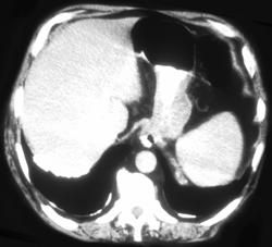 Asbestos Related Plaques - CTisus CT Scan