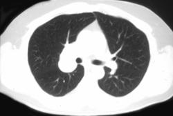 Small Cell Lung Cancer - CTisus CT Scan