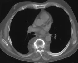 Paraspinal Fat Simulates A Mass - CTisus CT Scan