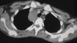 Bronchogenic Cyst - CTisus CT Scan