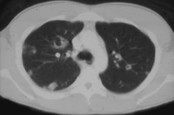 Septic Embolism - CTisus CT Scan